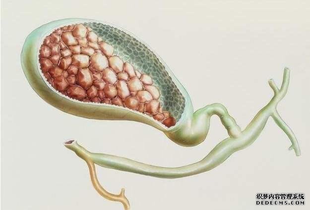 胆结石怎么吃?医生告诉你:7类食物禁忌,四级预防让你远离结石