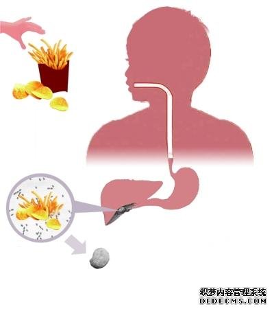 胆结石怎么吃?医生告诉你:7类食物禁忌,四级预防让你远离结石