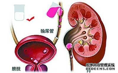 肾结石疼起来很要命!做好11点早预防