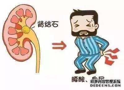 肾结石疼起来很要命!做好11点早预防