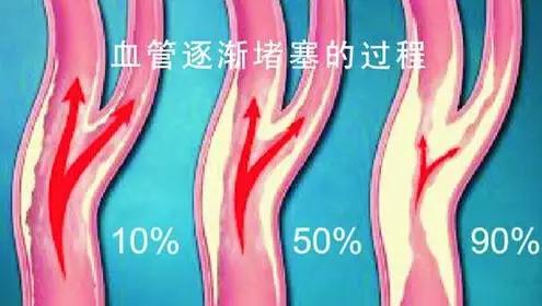 揭露“三高”真相:高血压、高血脂、高血糖