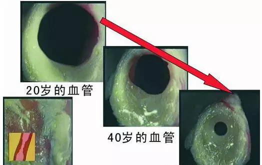 揭露“三高”真相:高血压、高血脂、高血糖