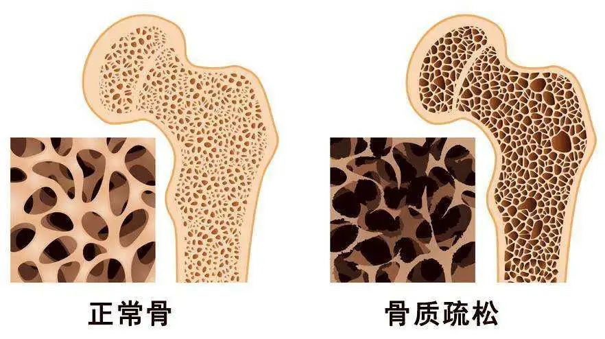 世界骨质疏松日 | 预防“骨质疏松”补钙就可以了吗?营养专家送你一份“护骨秘籍”