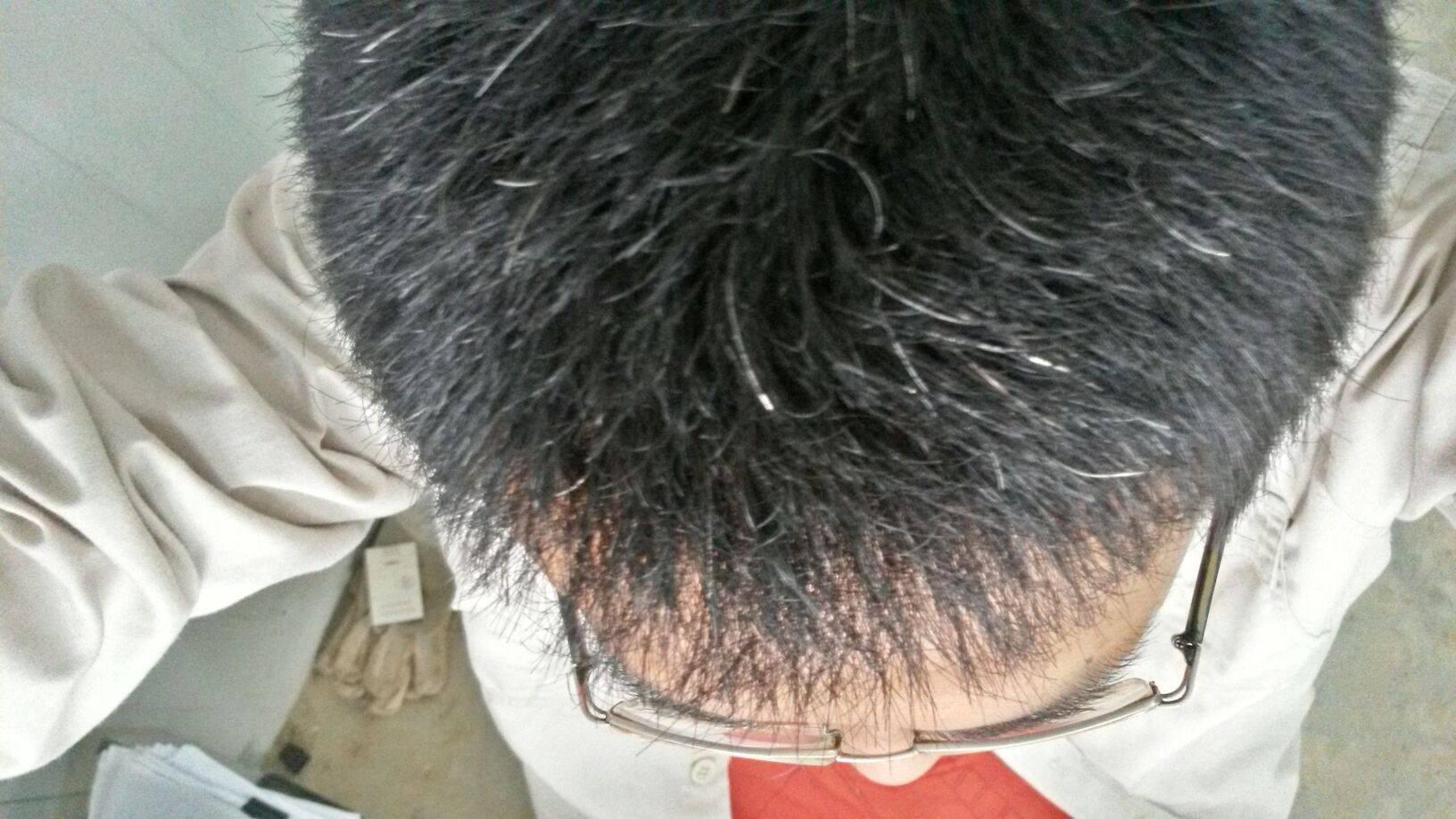 白发越长越多,并非变老的信号,可能是身体缺乏这3种元素了