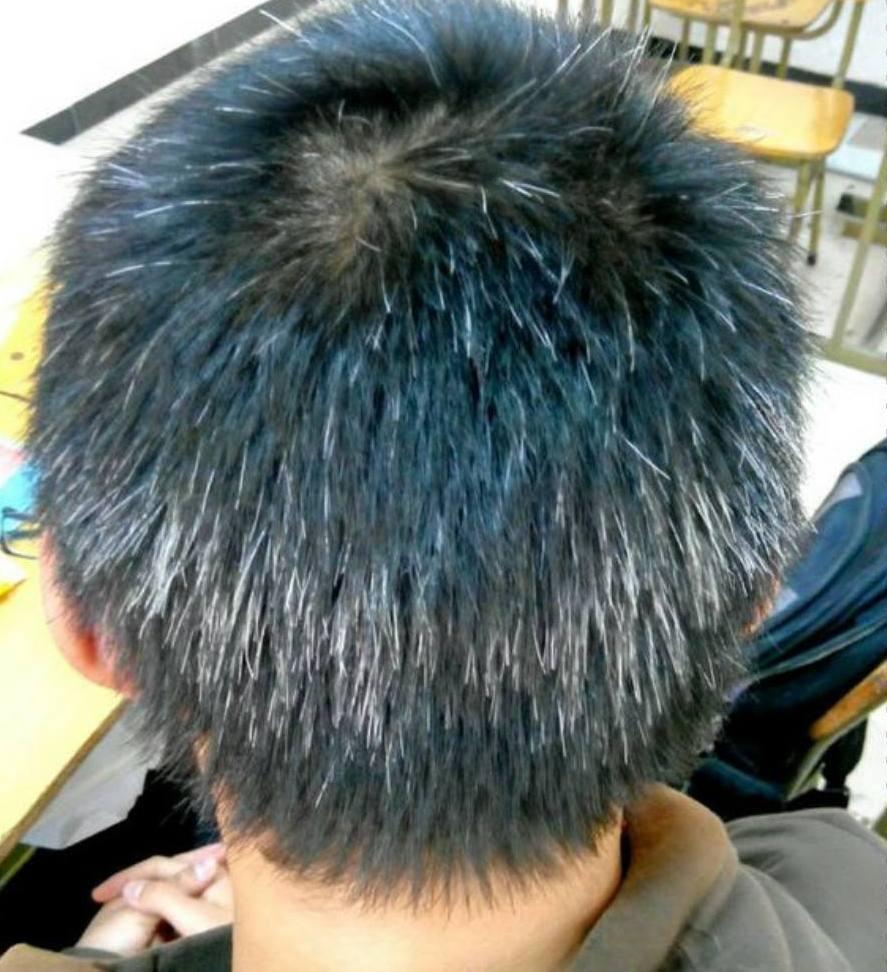 白发越长越多,并非变老的信号,可能是身体缺乏这3种元素了